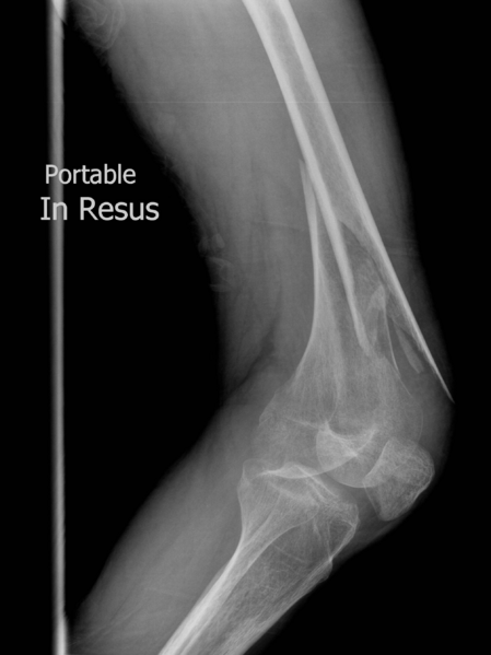 File:Distal-femoral-fracture.png