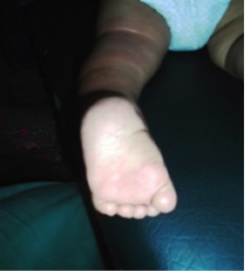 Case Study-Idiopathic Unilateral Clubfoot 4.png