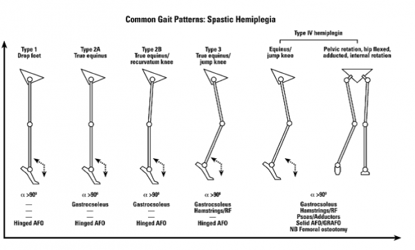 Common Gait patterns spastic Hemiplegia.png
