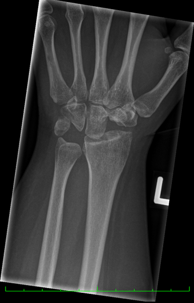 File:Left hand post proximal row carpectomy.png