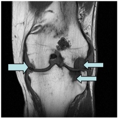 MRI for knee OA.jpg