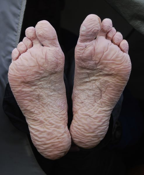 File:Trench foot.jpg
