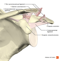 Acromioclavicular separation type 3 Primal.png