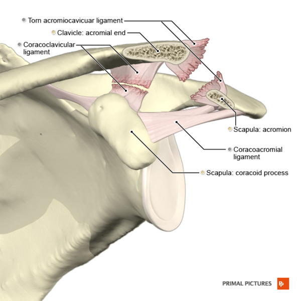 File:Acromioclavicular separation type 3 Primal.png