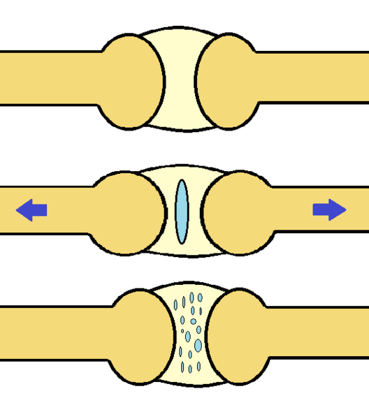 File:Joint-cavitation.png