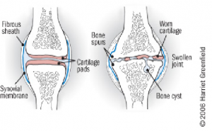 osteoartrite degenerativa articulațiile ulnare și genunchi doare