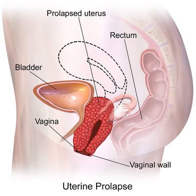 Uterine Prolapse - Physiopedia