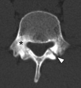 Spondylolysis CT scan (1).docx.jpg