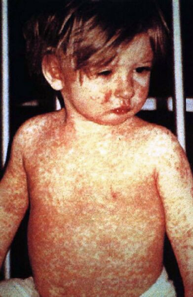 File:Measles .jpeg
