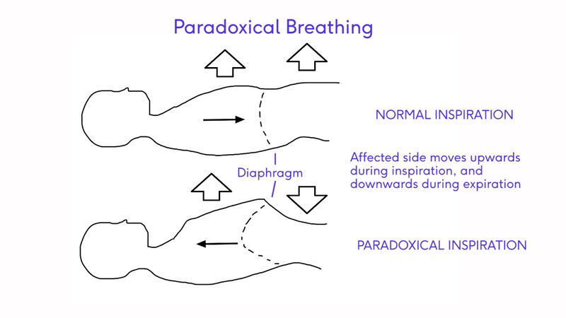 File:Paradoxical Breathing Image - recreated with labels.jpg