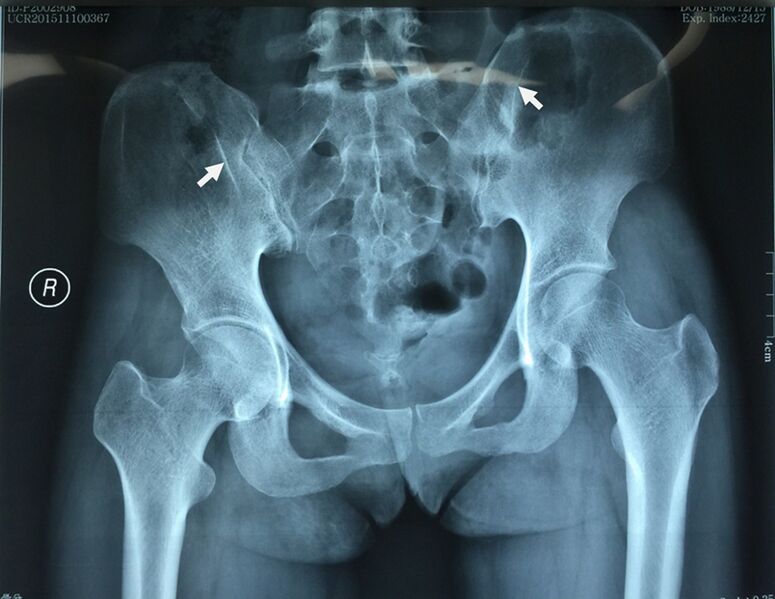 File:Radiograph for bilateral gluteal muscle contracture.jpg
