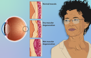 1024px-Depiction of a woman suffering from Age-related Macular Degeneration (AMD).png