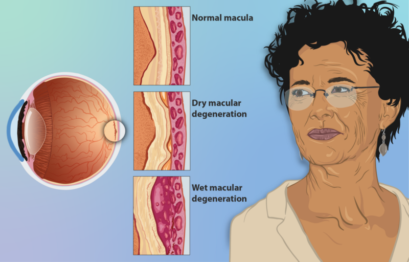 File:1024px-Depiction of a woman suffering from Age-related Macular Degeneration (AMD).png