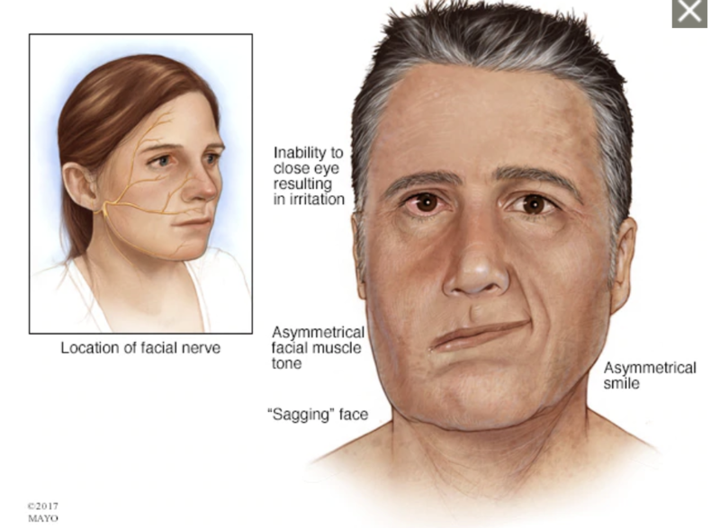 File:Bell's Palsy- Facial Droop.png