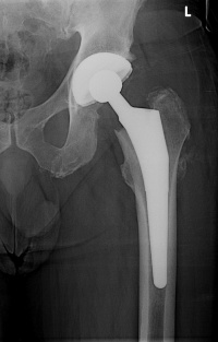 Total Hip Replacement X-ray