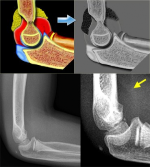 Supracondylar Humeral Fracture - Physiopedia