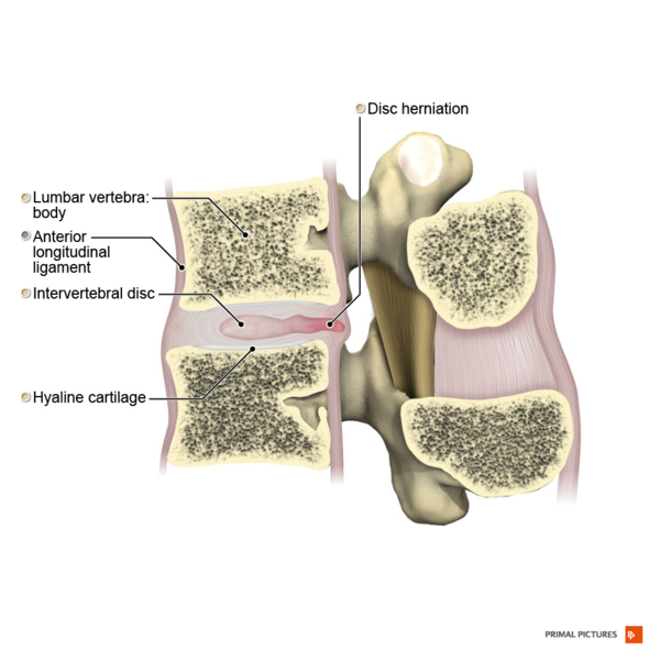 File:Posterior disc hernia sagittal view Primal.png