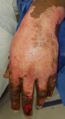 Example of wound oedema in hand and fingers