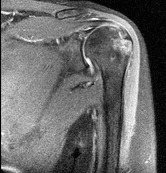 File:Greater-tuberosity-avulsion-fracture-and-SLAP lesion.jpeg