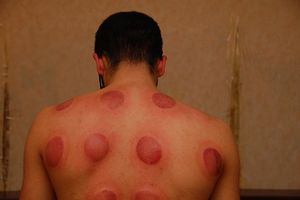 Side effects cupping.jpg