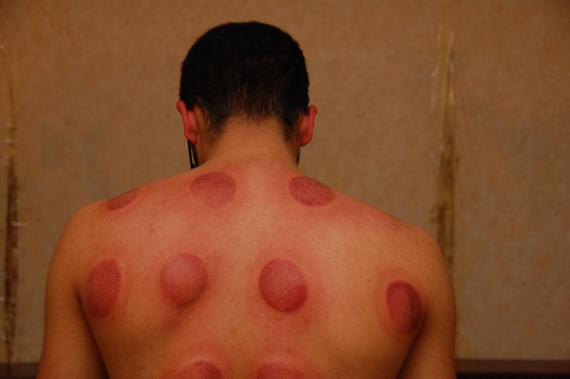 File:Side effects cupping.jpg
