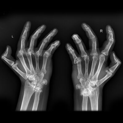 Rheumatoid-arthritis-hands-3.jpeg