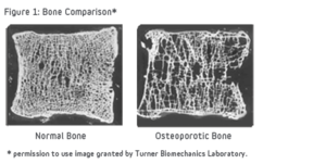 Bone Comparison of Healthy and Osteoporotic Vertibrae.png