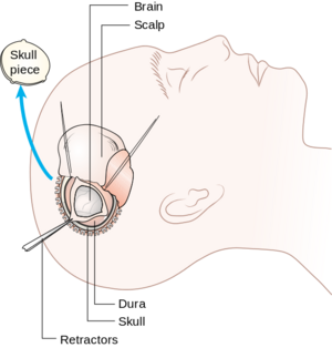 Schematic drawing showing the operative technique chosen for patients