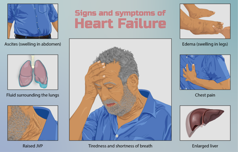 File:Depiction of a person suffering from heart failure.png
