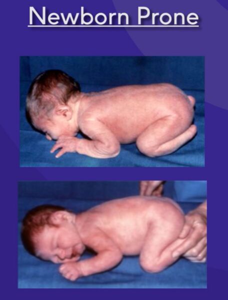 File:Newborn prone.jpg