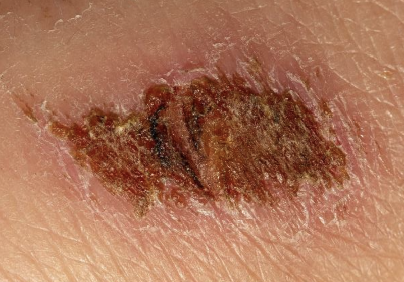 File:Scab.png