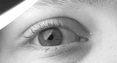 Image 1: Left eye of male with congenital nystagmus in a rapid horizontal motion.