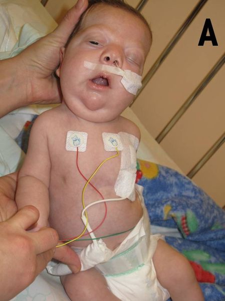 File:Eyebrow slant and left-side eyelid dropping of a 3 months old infant with Noonan Syndrome.jpg