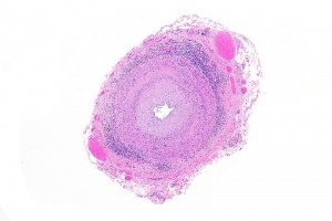 Giant cell arteritis -- very low mag.jpg