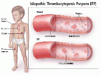 Idiopathic-Thrombocytopenic-Purpura.gif