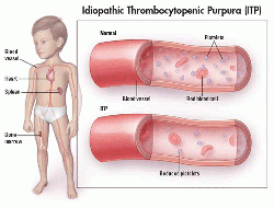Available from: http://www.childrenshospital.org/conditions-and-treatments/conditions/immune-thrombocytopenic-purpura-itp