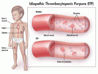 Idiopathic-Thrombocytopenic-Purpura.gif