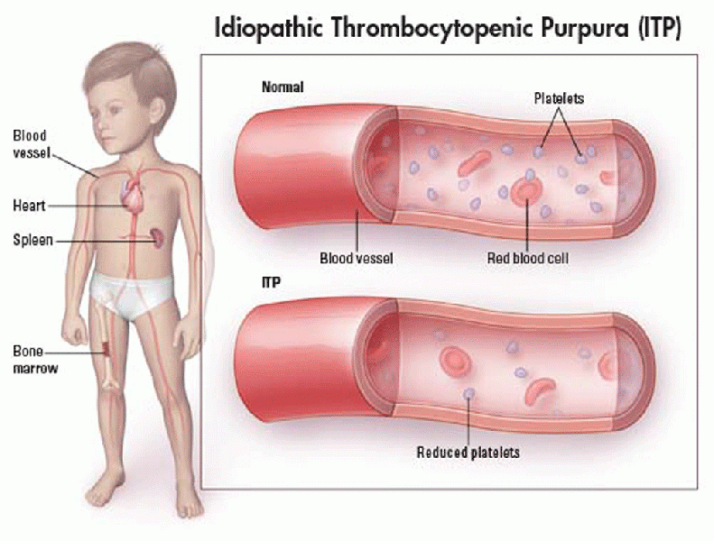 File:Idiopathic-Thrombocytopenic-Purpura.gif