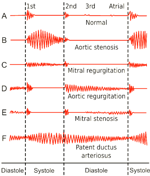 File:Heart Sounds.png