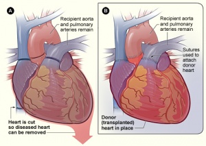 Heart transplant NIH.jpg