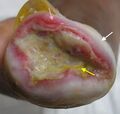 Yellow area denotes slough, pink arrow shows new epithelial cells, white arrow highlights areas of periwound maceration. Differentiating tissue types is important for debridement purposes.