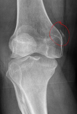 ruski naselja liječenje osteoartritisa tablete protiv bolova za preglede bolova u zglobovima