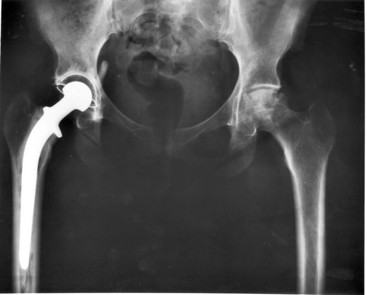 File:Hip replacement Image 3684-PH.jpg