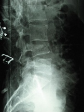 L4 compression fracture on radiograph