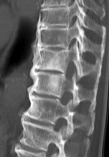 dish hyperostosis skeletal diffuse idiopathic forestier disease radiopaedia ossification flowing spine radiology definition edit physiopedia mip source case prevalence pedia