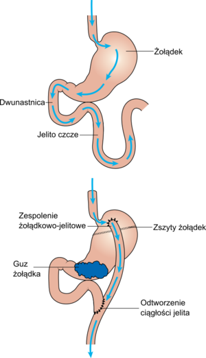 Stomach bypass surgery CRUK 108 pl.png