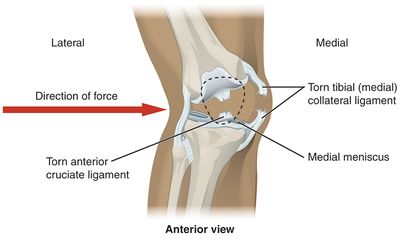 Can You Still Walk With A Torn Mcl Or Acl Medial Collateral Ligament Of The Knee Physiopedia