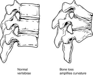 Osteoprosis of Spine.jpg