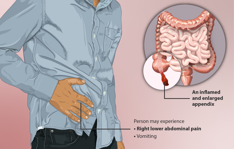 File:Appendicitis depiction.png