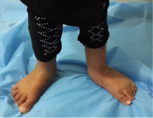 Case Study - Clubfoot with Post-Surgical Relapse - Long Term.png